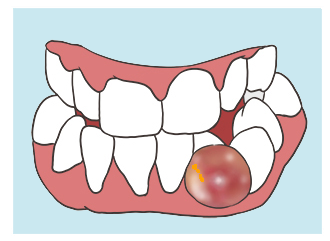 牙包肿痛怎样马上消除图片