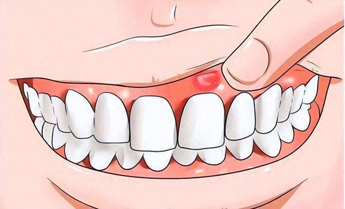 怀孕牙龈红肿增生怎么回事