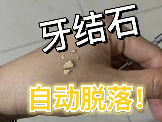 日常去除牙结石的方法立马学,简单又有效,在家就能操作!