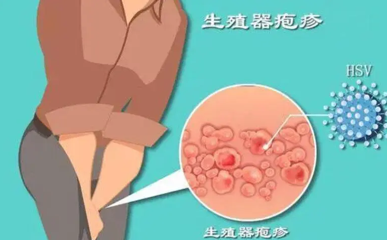 生殖器疱疹能根治吗?长沙皮肤病医院解答