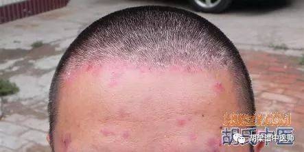该例为胡梁谱医师治疗之黄先生,初始面部红肿斑,头发部密布银屑,看不