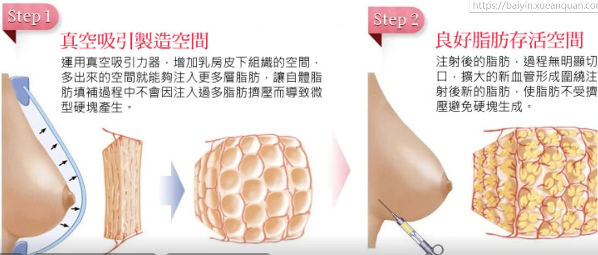 做过手术的过来讲讲自体脂肪隆胸5年后会如何,脂肪抽脂丰胸好么_细胞