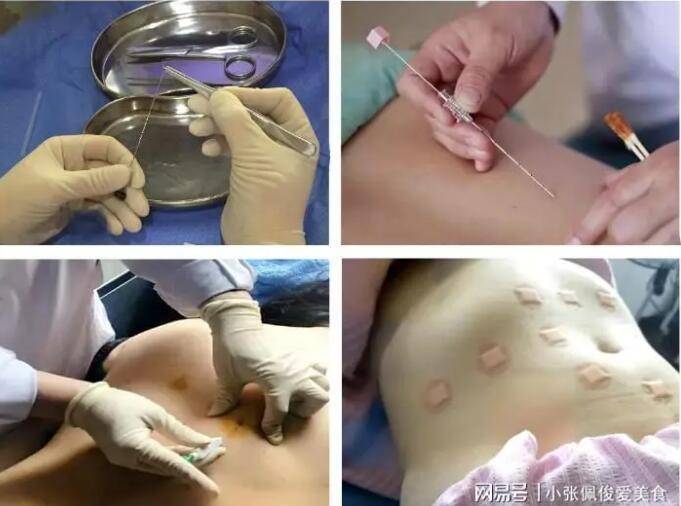 上海金博芙门诊埋线减肥塑形凝聚健康美_脂肪_穴位_人体