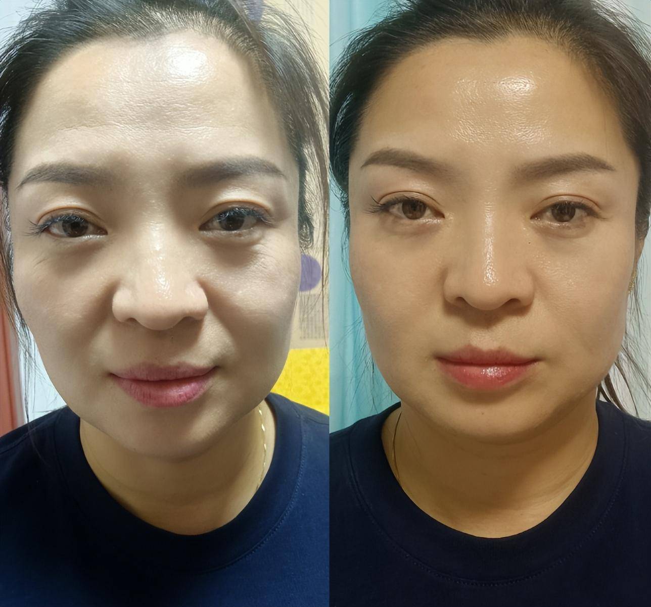 杨氏飞针自然美,让您灵感无处不在_美容_面部_传承