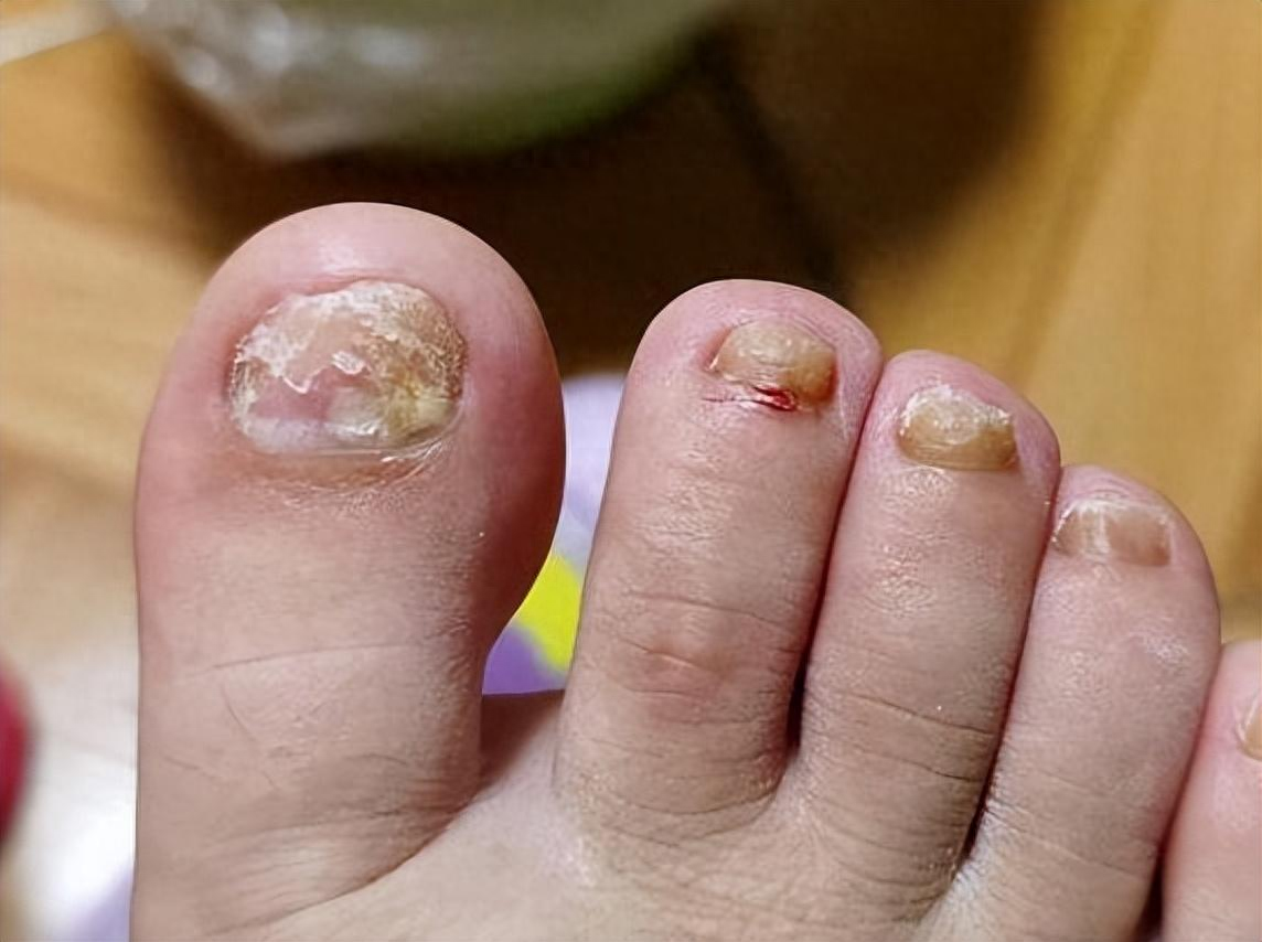 得了灰指甲,一个传染俩?教你3招,在家也能根治灰指甲!