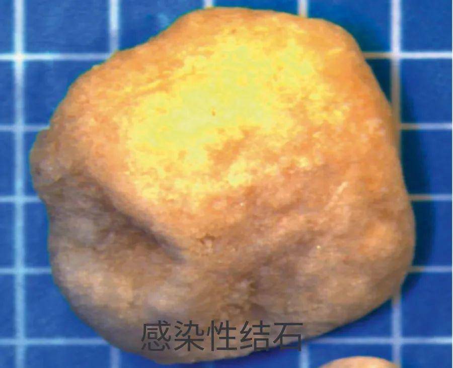 2,磷酸钙结石:是第二常见的结石类型,以碳酸磷灰石多见,多为圆形,表面