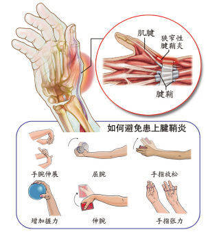 经常握鼠标的人这样缓解腱鞘炎的疼痛