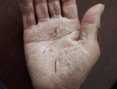 真心建议:双手脱皮干裂仅仅靠它就能成功上岸!效果太顶了!