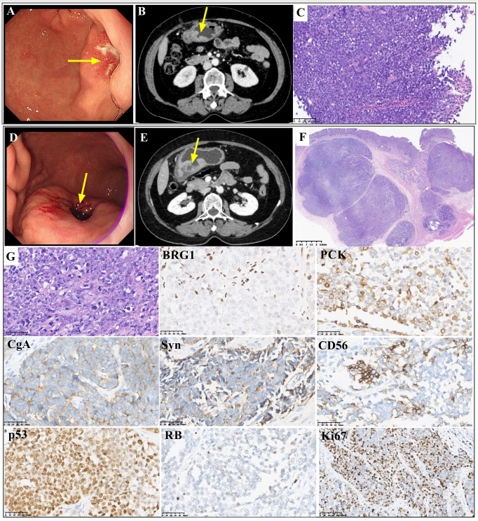 谈谈smarca4缺陷型胃肠神经内分泌癌的临床特征_肿瘤_细胞