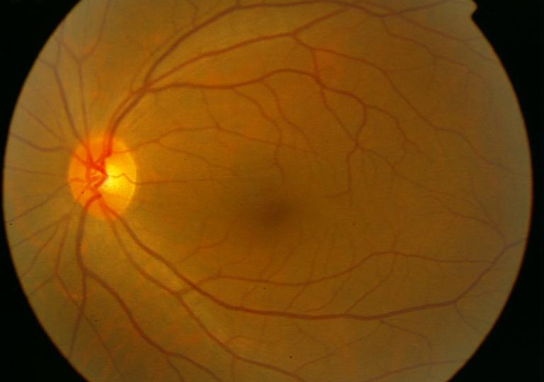 糖尿病是如何导致视网膜病变的?武汉普瑞眼科医院许泽骏院长带您揭秘_