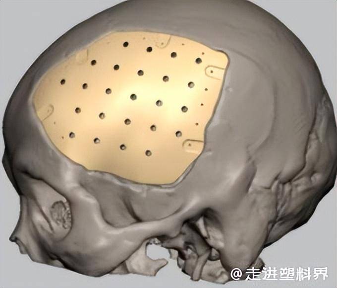 颅骨修补图片