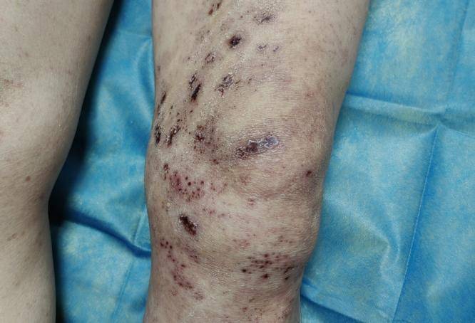 六旬阿姨腰腿钻心痛,元凶竟是"带状疱疹"_治疗_神经痛_患者