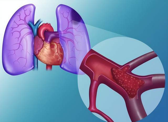 久坐办公,肺栓塞正潜伏在长时间久坐后——做好早期预防