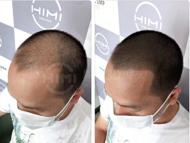 黑米3d纹发:雄激素正常,为什么还会雄脱?_毛囊_头发_形象