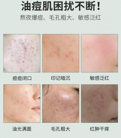 美体小铺茶树精油美体小铺的茶树精油是祛痘的经典产品之一,真的是