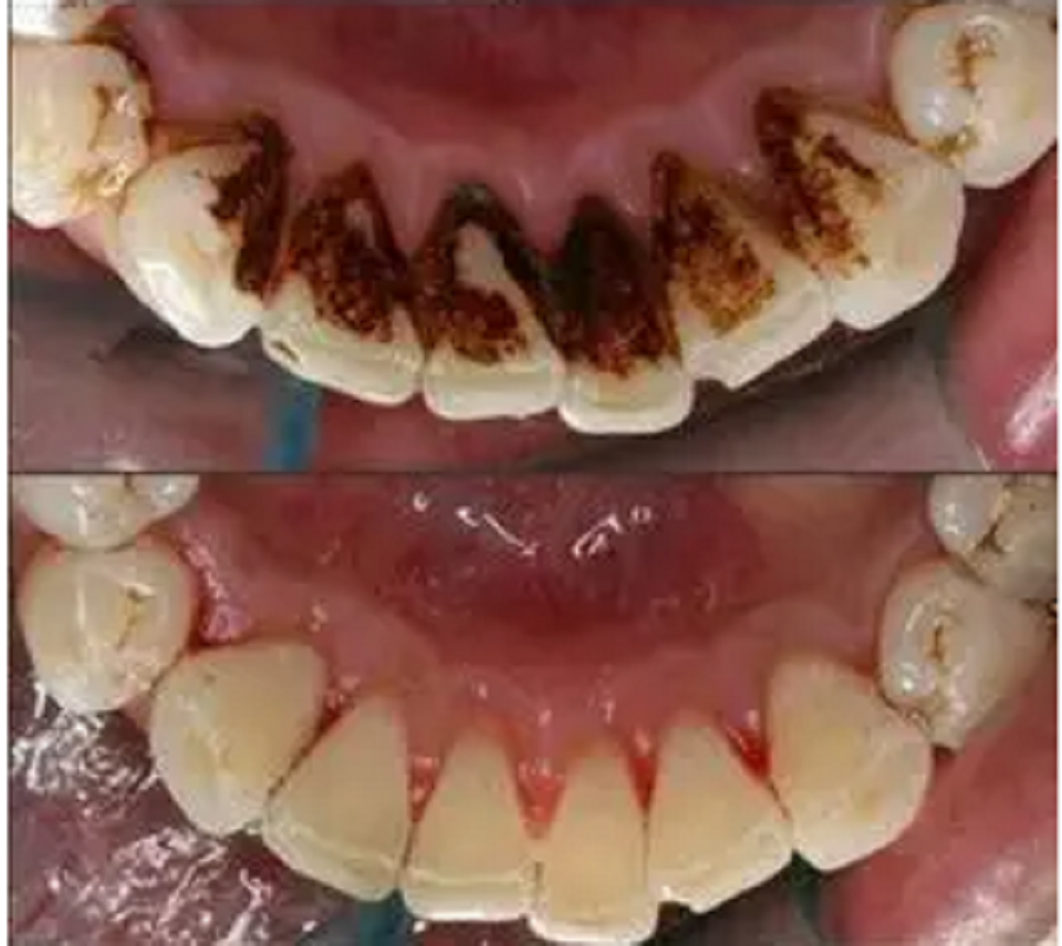 牙粉_牙齿_牙膏