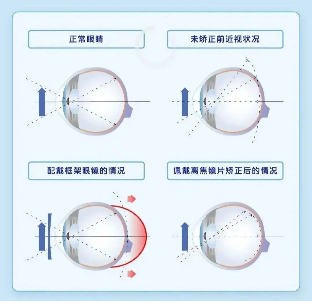 发育过快,即眼轴增长过快,远视储备快速消耗到0,从远视向近视发展时