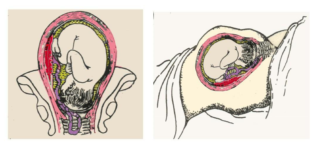 胎头着冠与拨露的图图片