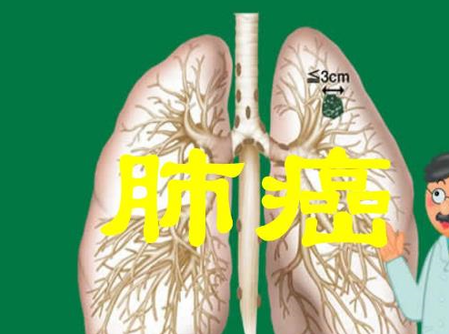 到了肺癌晚期,患者会变成什么样?看完后你就知道了!