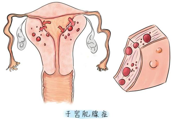 腺肌症对胚胎移植和着床的直接影响