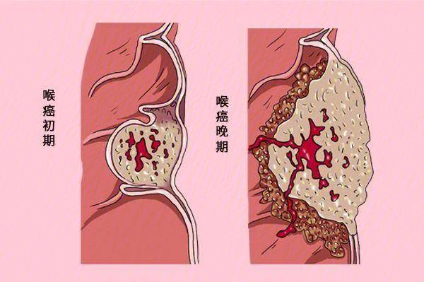 风险_症状_声带