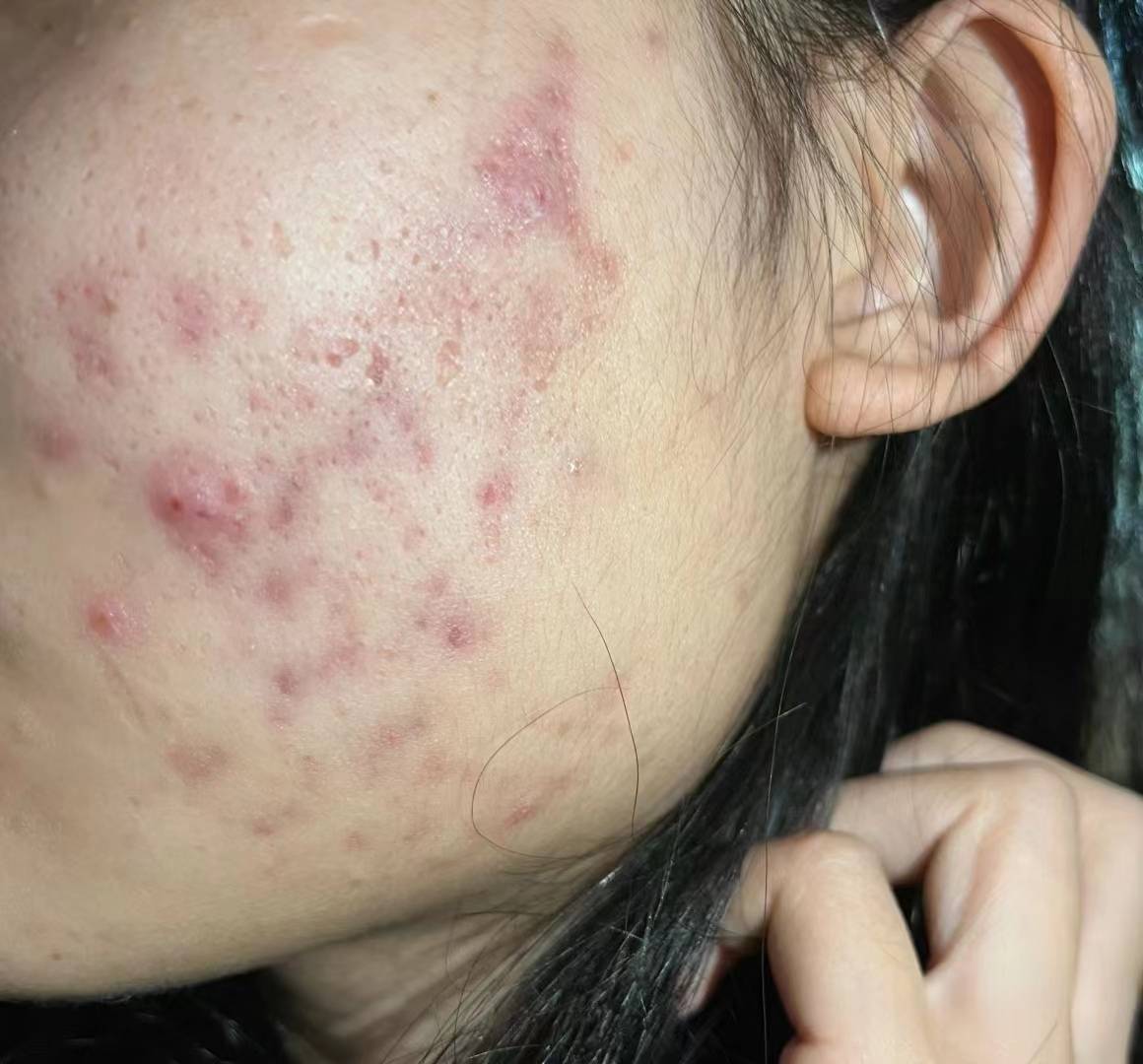 简单3步精准去痤疮简单有效在家就可操作可惜太少人知道