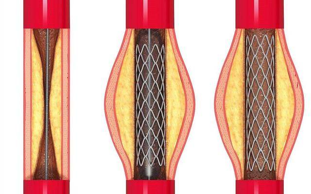 球形心脏支架图片