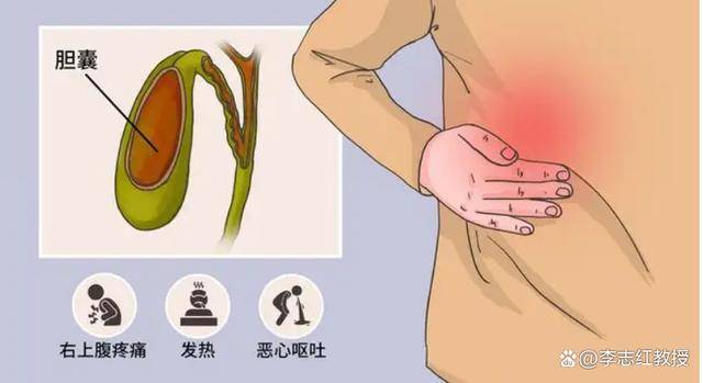 胆囊炎患者可以吃鸡蛋吗医生真正应该忌口的是这2类食物