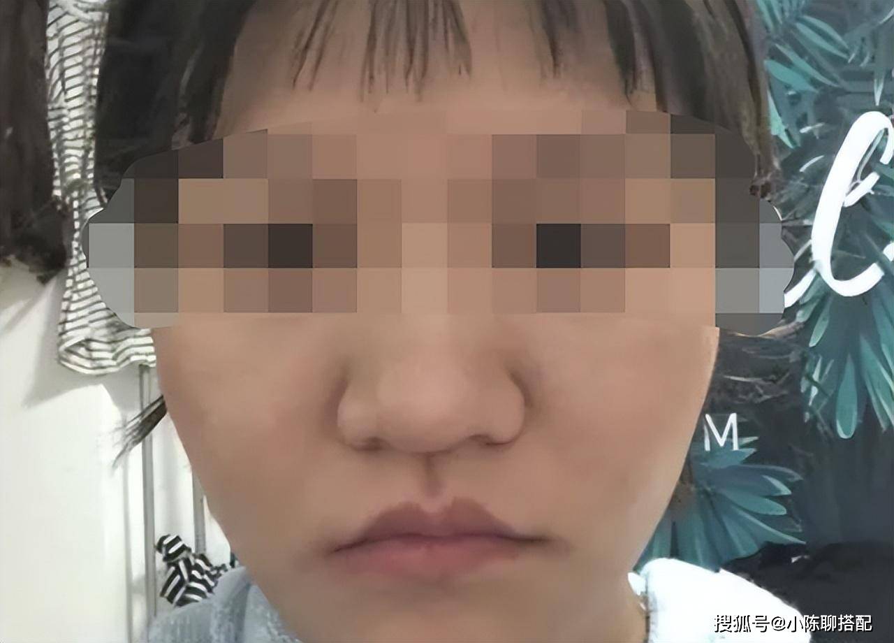 而是鼻尖肥大,鼻翼沟不明显,软组织肥厚,看起来横向延伸了面部的扁平