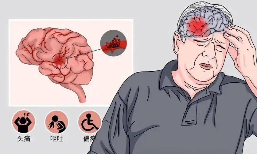 原创血型决命运60万研究人群揭秘a型血中风风险