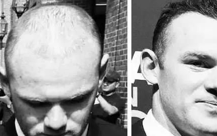 鲁尼先看看名人们的植发效果对比