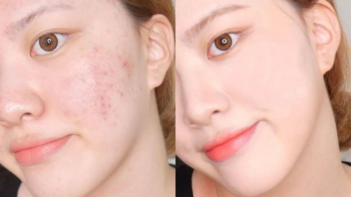 祛痘印产品哪个好用这几款是大牌平替超具性价比