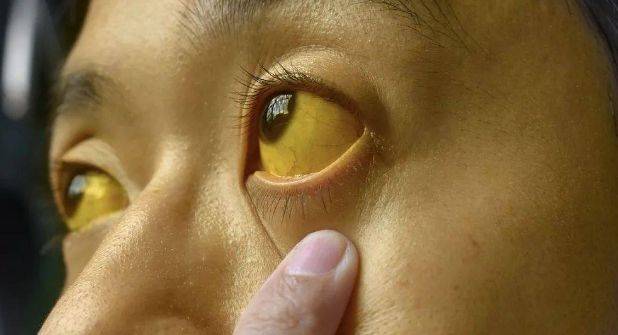 皮肤瘙痒:主要原因是考虑胆红素升高,因为胆红素升高会容易出现沉积于