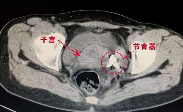 宫形环在子宫内图片图片