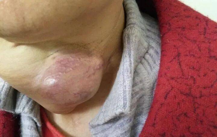 体检出现甲状腺结节其中515是恶性出现这些症状要注意了