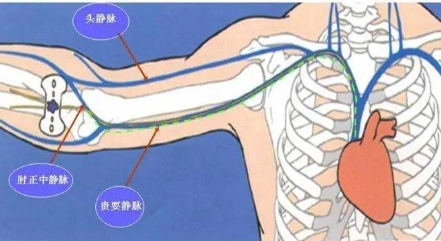 肘正中静脉输液图片