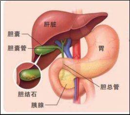 胆囊结石小知识_胆固醇_胆汁_手术