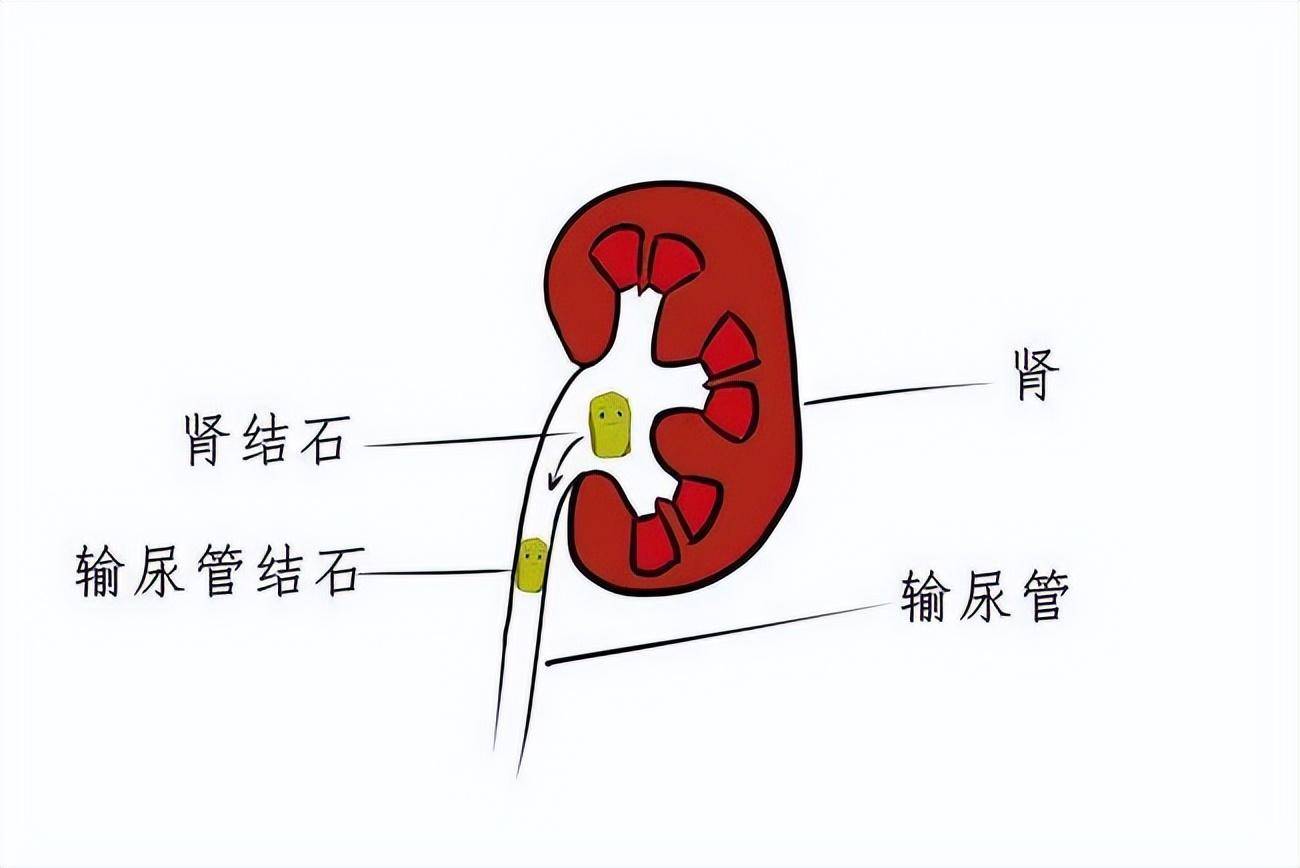 尿路结石位置图片