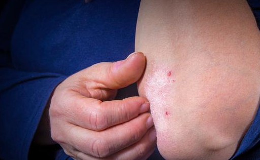 银屑病的1类创新药本维莫德上市彻底击碎外不治癣窘境