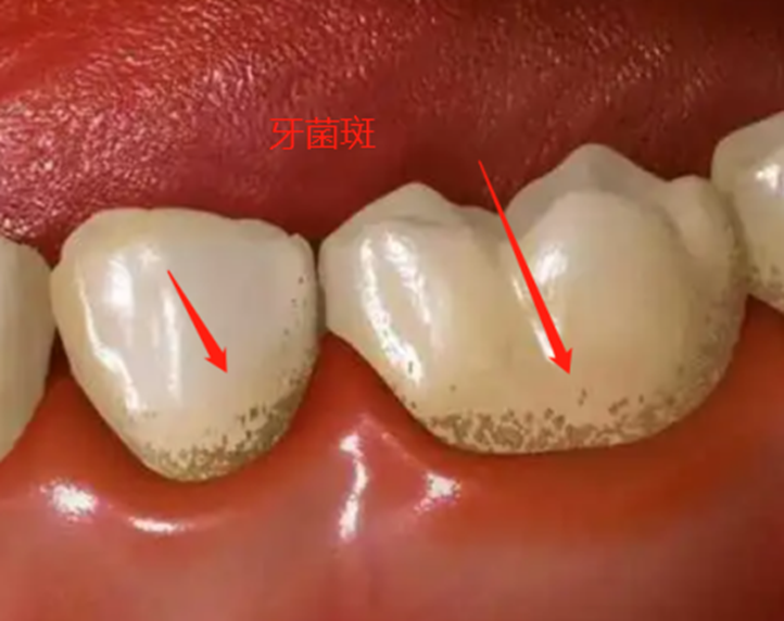 牙齿矫正正畸须知远离19大护理副作用雷区