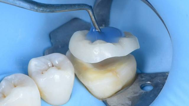 除了全冠,牙体缺损还有哪些恢复牙体组织的办法呢?