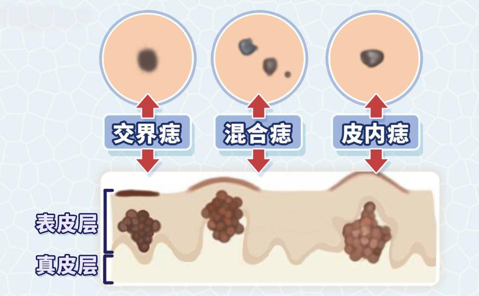 长沙鸿业疤痕科普 疣状痣 皮肤上的小山丘