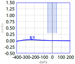 左耳声导抗-b型鼓室图3,电耳镜或耳内镜检查:在早期鼓膜可见轻度充血