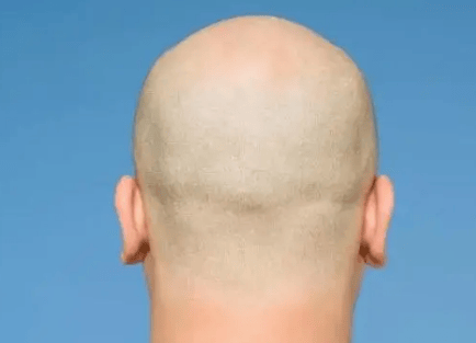 黑米3d纹发:植发后,被取掉的毛囊还能长出来吗?