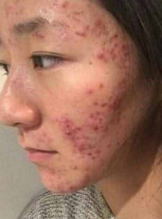 原创闭合粉刺囊肿痘痘黑头用这个方法最有效20天搞定不再复发