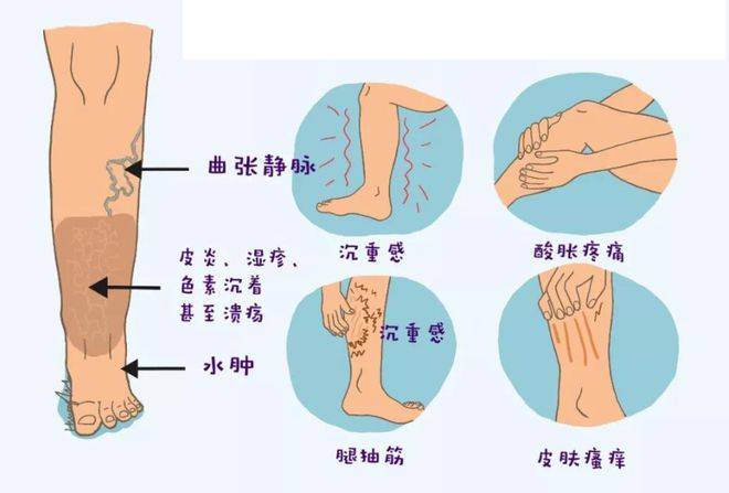 下肢静脉曲张卡通图片