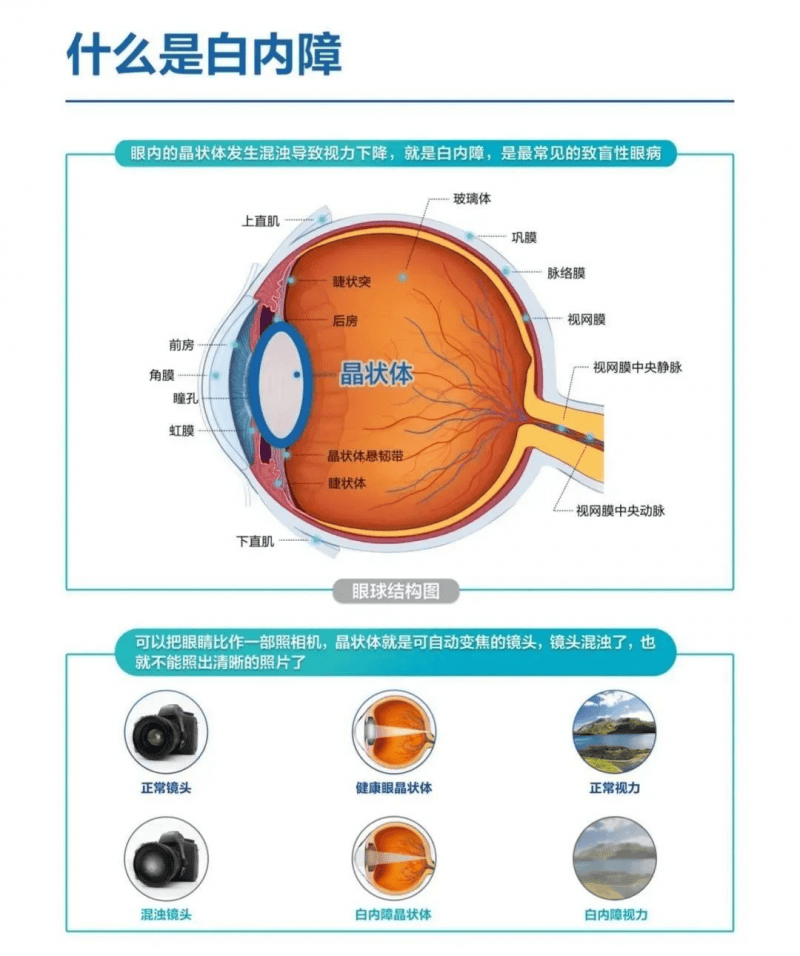 白内障的类型图片图片