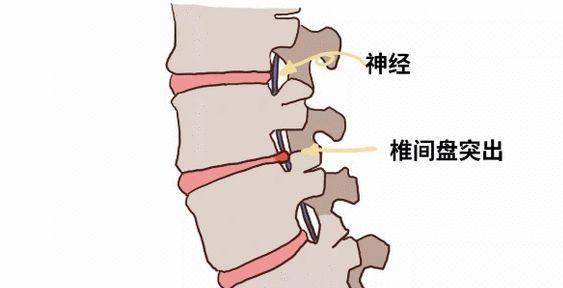 腰椎间盘突出到底怎么回事