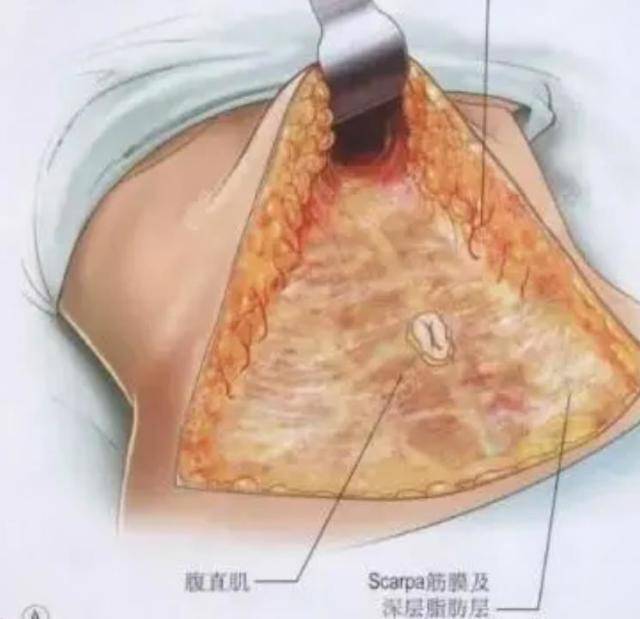 腹部拉皮手术前后照片?拉皮一般大概多少钱?看过不淡定了