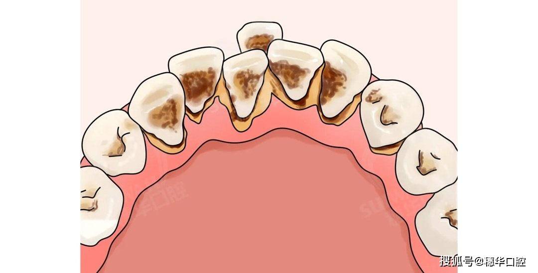 抽烟的男生牙齿从里到外都是烟渍,黄渍应该怎么办?